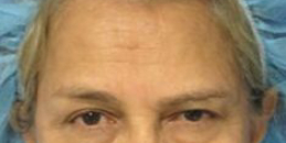 Facelift Before & After Patient #8481