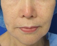 Neck Lift Before & After Patient #10055