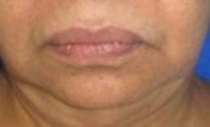 Neck Lift Before & After Patient #10034