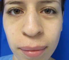 Rhinoplasty Before & After Patient #10306