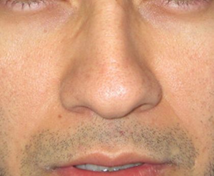 Rhinoplasty Before & After Patient #10293