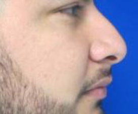 Rhinoplasty Before & After Patient #10219
