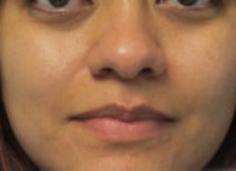 Rhinoplasty Before & After Patient #10150