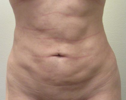 Back Before & After Patient #10988