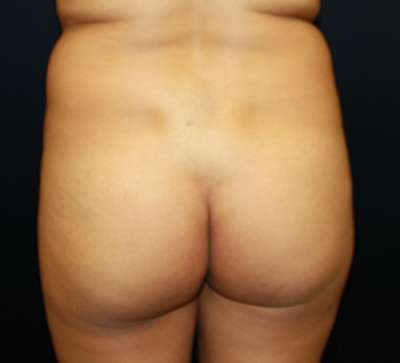 Brazilian Butt Lift Before & After Patient #6449