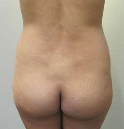 Brazilian Butt Lift Before & After Patient #6455