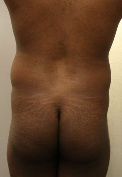 Brazilian Butt Lift Before & After Patient #6458