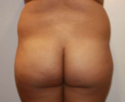 Brazilian Butt Lift Before & After Patient #6475