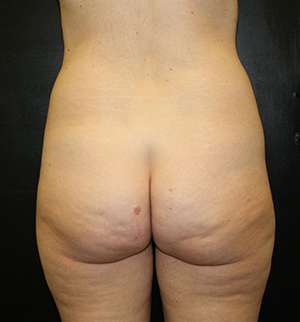 Brazilian Butt Lift Before & After Patient #6485