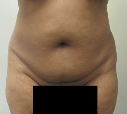 Abdomen Before & After Patient #5892