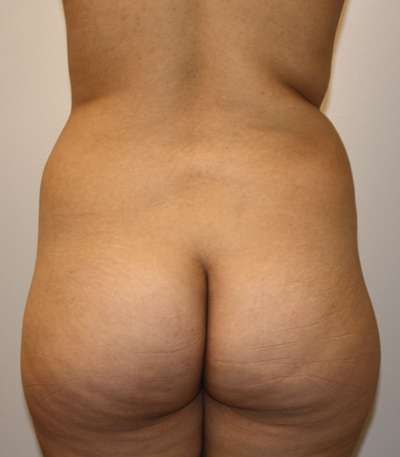 Brazilian Butt Lift Before & After Patient #6498