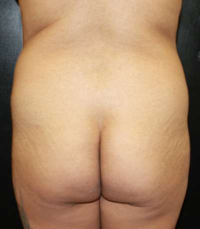 Brazilian Butt Lift Before & After Patient #6503