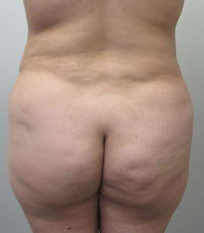 Brazilian Butt Lift Before & After Patient #6506