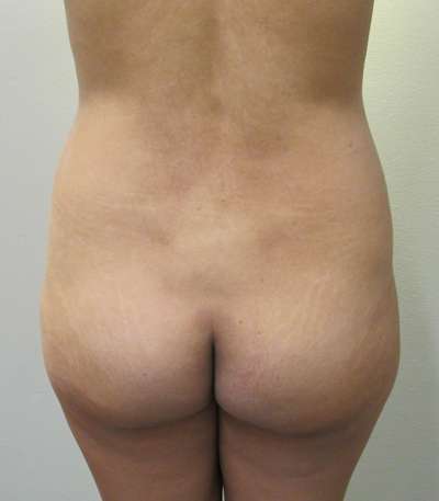 Brazilian Butt Lift Before & After Patient #6511