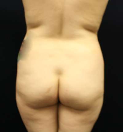 Brazilian Butt Lift Before & After Patient #6517