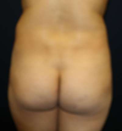 Brazilian Butt Lift Before & After Patient #6524