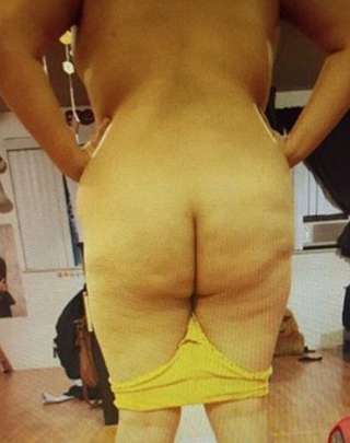 Brazilian Butt Lift Before & After Patient #6532