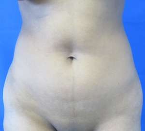 Brazilian Butt Lift Before & After Patient #6548