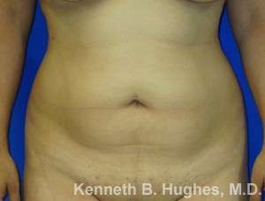 Brazilian Butt Lift Before & After Patient #6557
