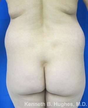 Brazilian Butt Lift Before & After Patient #6575