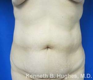 Brazilian Butt Lift Before & After Patient #6582