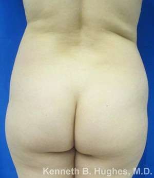 Brazilian Butt Lift Before & After Patient #6596