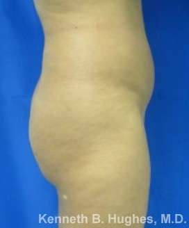 Brazilian Butt Lift Before & After Patient #6599