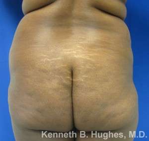 Brazilian Butt Lift Before & After Patient #6605
