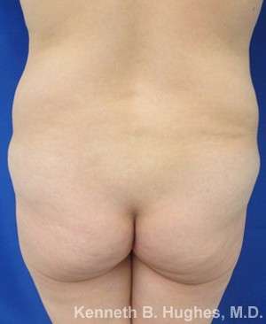 Brazilian Butt Lift Before & After Patient #6608