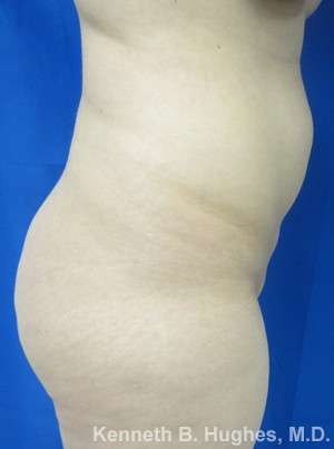 Brazilian Butt Lift Before & After Patient #6611