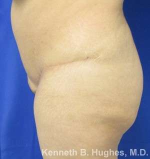 Brazilian Butt Lift Before & After Patient #6616