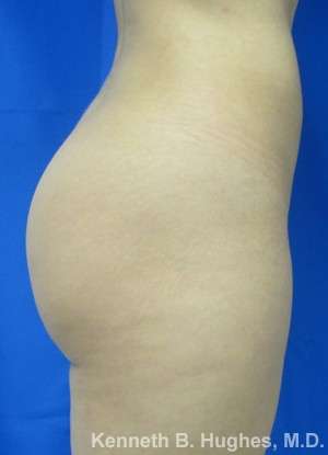 Brazilian Butt Lift Before & After Patient #6624