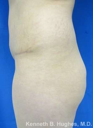 Brazilian Butt Lift Before & After Patient #6627