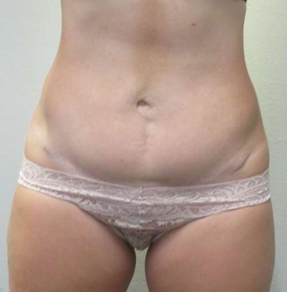 Abdomen Before & After Patient #5907