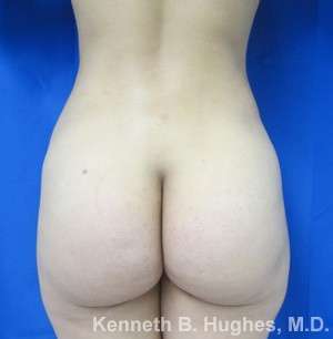 Brazilian Butt Lift Before & After Patient #6640