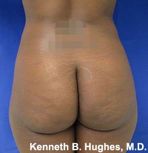 Brazilian Butt Lift Before & After Patient #6647