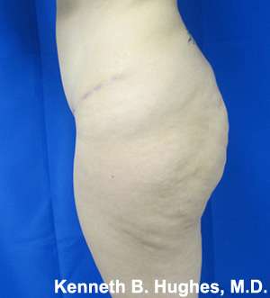 Brazilian Butt Lift Before & After Patient #6652