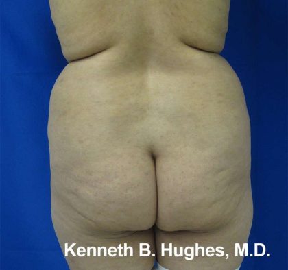 Brazilian Butt Lift Before & After Patient #6655