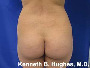 Brazilian Butt Lift Before & After Patient #6660