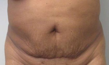 Abdomen Before & After Patient #5910