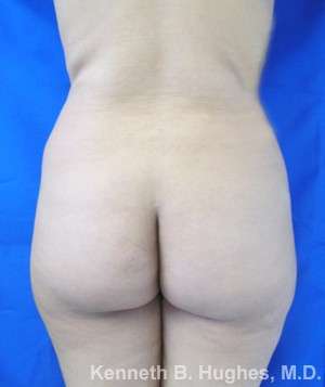 Brazilian Butt Lift Before & After Patient #6691