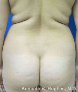 Brazilian Butt Lift Before & After Patient #6702