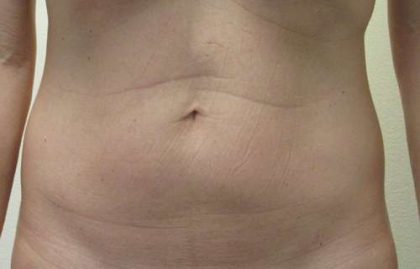 Abdomen Before & After Patient #5913