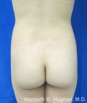 Brazilian Butt Lift Before & After Patient #6723