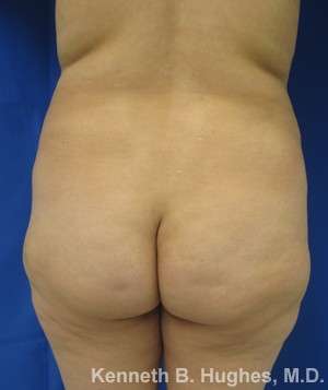 Brazilian Butt Lift Before & After Patient #6733