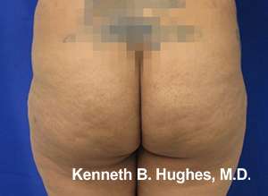 Brazilian Butt Lift Before & After Patient #6749