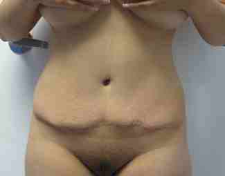Brazilian Butt Lift Before & After Patient #6752