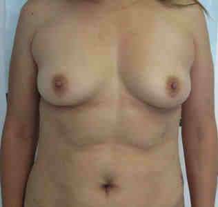 Liposuction Before & After Patient #6755