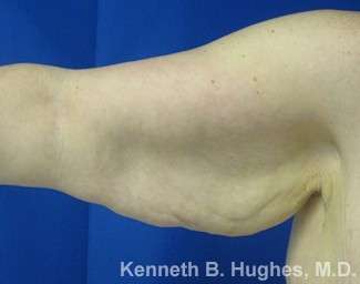 Arm Lift Before & After Patient #5918