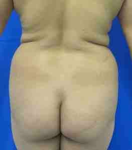 Brazilian Butt Lift Before & After Patient #6760